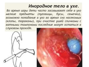 Ощущение в ухе постороннего предмета