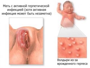Генитальный герпес на 13 неделе беременности