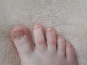 Грибок ногтей у ребенка в 1 год