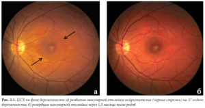 Осмотр глазного дна до беременности