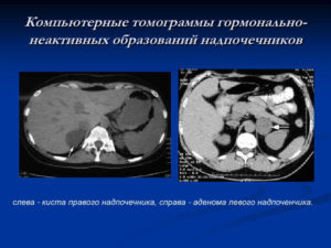 Образования в надпочечниках