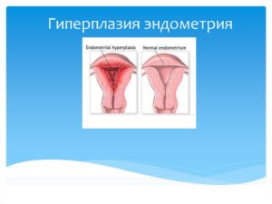Гиперплазия эндометрия после родов