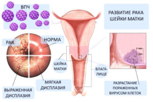 Хроническая болезнь матки, вирус паппиломы высокого онкогенного риска, эндометриоз