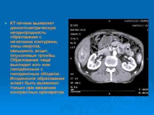 Образования в печени на кт