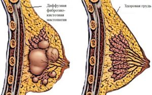 Фиброзно-кистозная мастопатия (единичная киста)