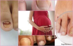 Грибок во время беременности