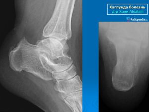 Остеохондропатия пяточной кости