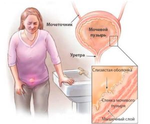 Ноет низ живота, ощущение неполного испражнения мочевого пузыря