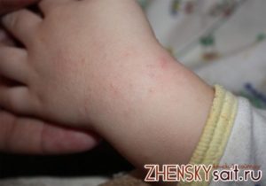 От чего может быть сыпь на руках у ребенка?