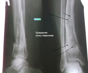 Не срастается перелом голени у кормящей