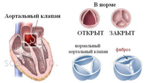 Фиброз МК