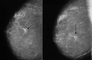 Обнаружили подозрительные участки на маммографии