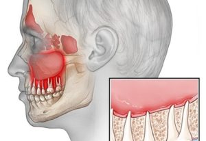 Одонтогенный гайморит