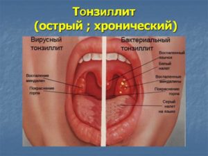 Образование на задней стенке глотки