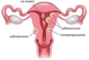 Фитотерапия при полипе эндометрия и миоме