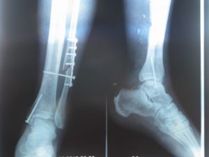 Перелом большой и малой берцовых костей правой ноги