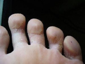 Облазиет кожа вокруг пальцах ног