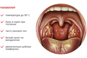 Головная боль отдает в зубы при хроническом тонзиллите