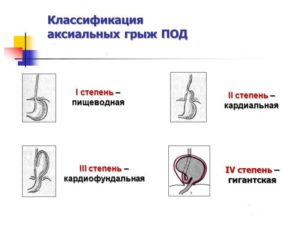 Грыжа пищевода 3-степени