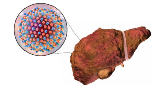 Гепатит С обнаружен в 2015