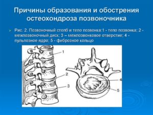 Обострение остеохондроза