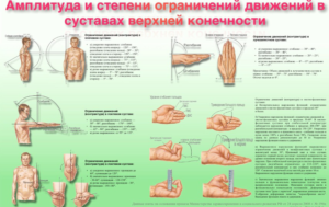 Ограниченная подвижность плеча