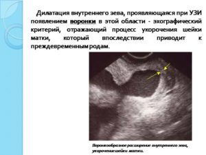 Открытие внутреннего зева на 28 неделе беременности