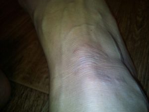 Непонятная сухая болячка на коже ноги