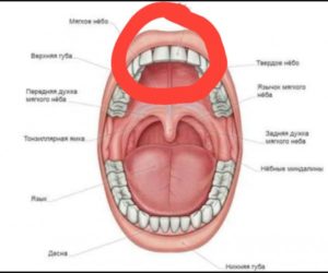 Опухла небо за передними зубами, воспаление