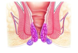 Фиолетовый узел около анального сфинктера