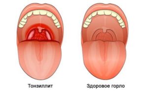 Одна миндалина красная и сильный кашель