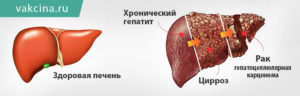 Гепатит С при онкологии что делать