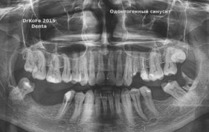 Односторонний одонтогенный гайморит