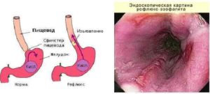 Горечь во рту, диагноз рефлюкс эзофагит