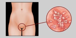 Генитальный герпес, частые рецидивы