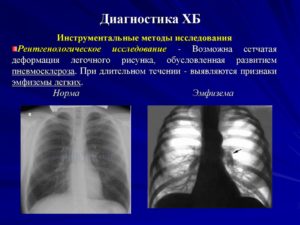 Фиброзная деформация легочного рисунка