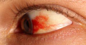 Небольшое кровоизлияние в глазу