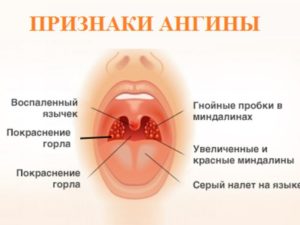 Гнойная ангина 3й раз