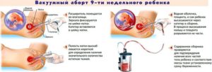Нет выделений после вакуумного аборта