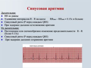 Паузы в сердечном ритме у ребенка