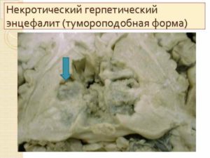 Некротический энцефалит у ребенка