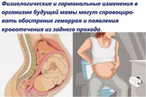 Геморрой при беременности
