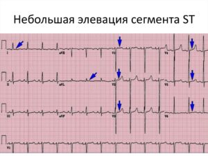 Неспецифиеские нарушения st-t (элевация)