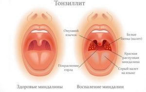 Гланды удалены, кашель, горло болит