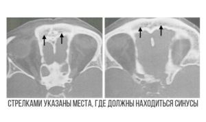 Гипоплазия правой гайморовой пазухи