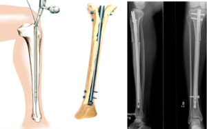 Остеосинтез после перелома большой берцовой кости