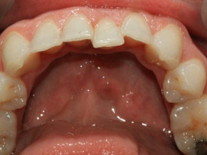 Очень болят нижние зубы
