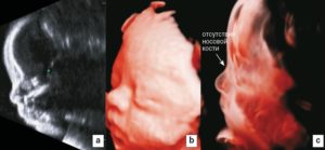 Отсутствие визуализации костей носа на УЗИ у плода в 12 недель