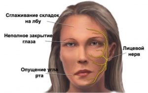 Головная боль. Онемение головы. Подергивание мышц лица