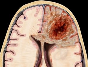 Глиобластома 4 стадии